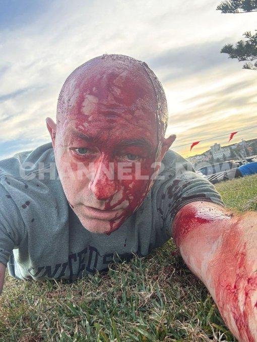 Human rights lawyer Arsen Ostrovsky shared a photo of himself after being shot at Bondi Beach in Sydney. He survived.